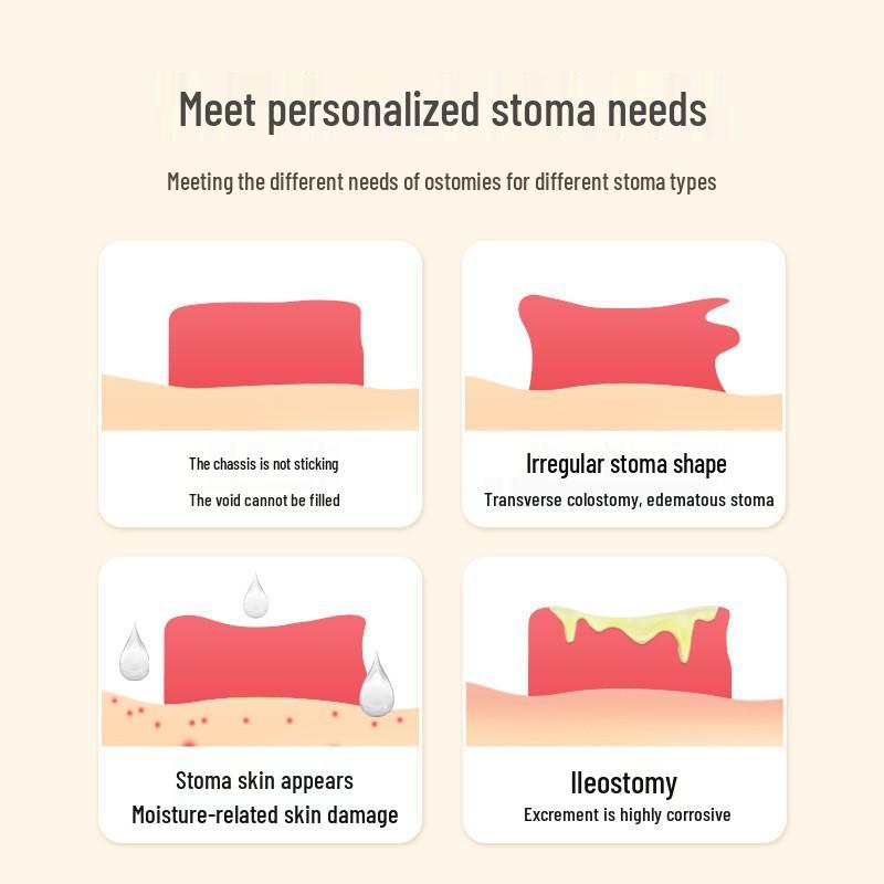 Anneau adhésif moulable étanche pour les soins de stomie - Plaque de base pour accessoire de colostomie
