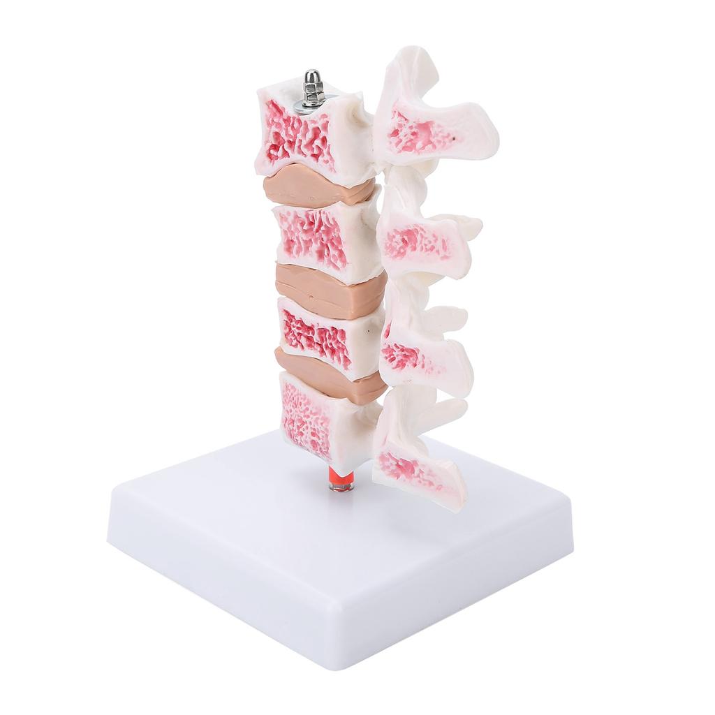 Professionelles Osteoporose-Modell, menschliches anatomisches Wirbelsäulenmodell für die Lehrdemonstration