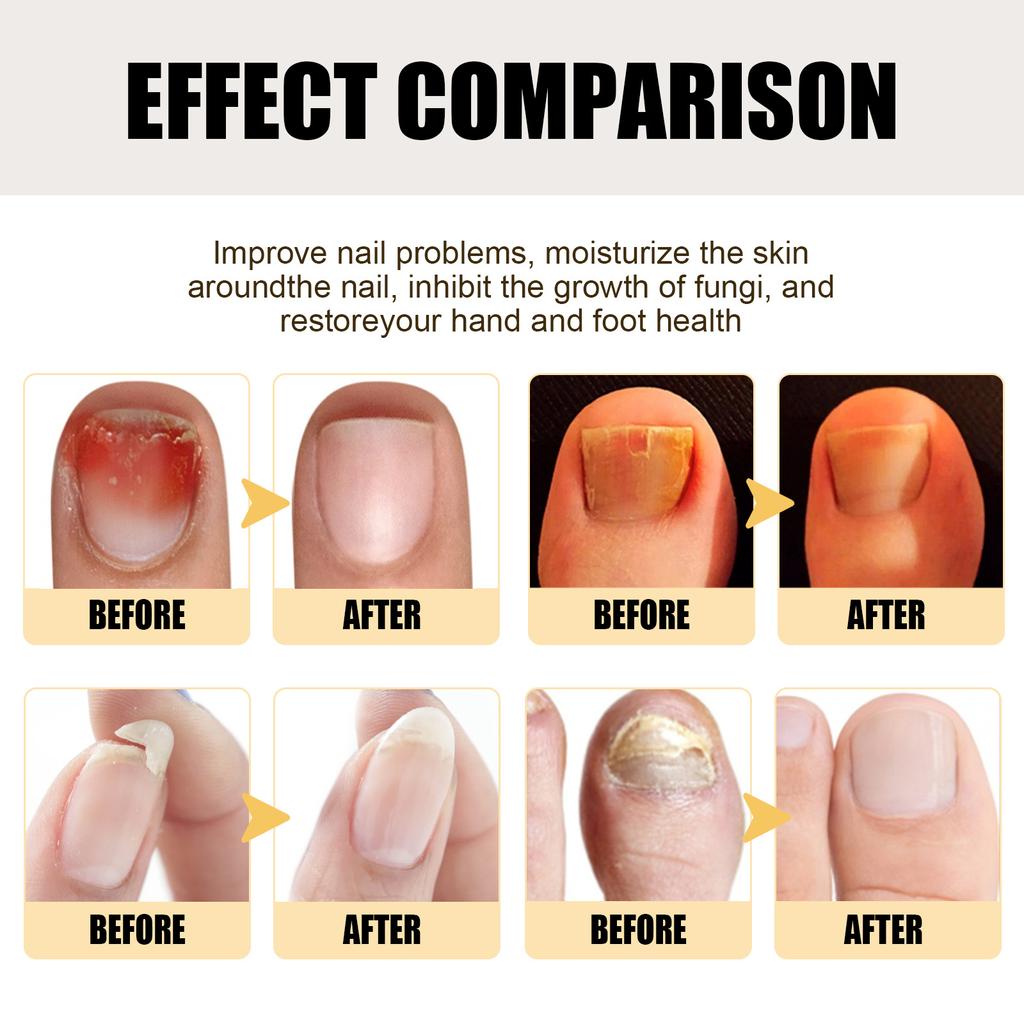 Nail Repair Essence Liquido Mani e Piedi Unghie Grigie Unghie Morbide Ingiallimento Unghie Spesse Lucide Pulizia Unghie Riparazione
