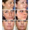 SMIATEY 1+1 Age Spot Removal Vita e Whitening Cream Crème Taches de vieillesse Imperfections 20 ml 1 unité, 2 contenants, 20 g