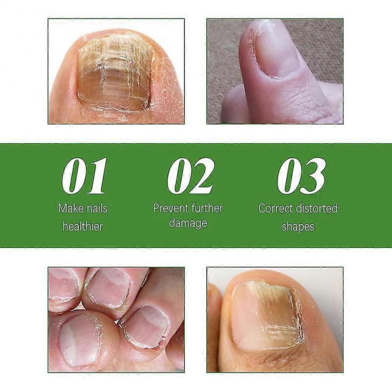 10ML Health Toenail Stick Roller Bead Onychomycosis Care Solution for Women Men