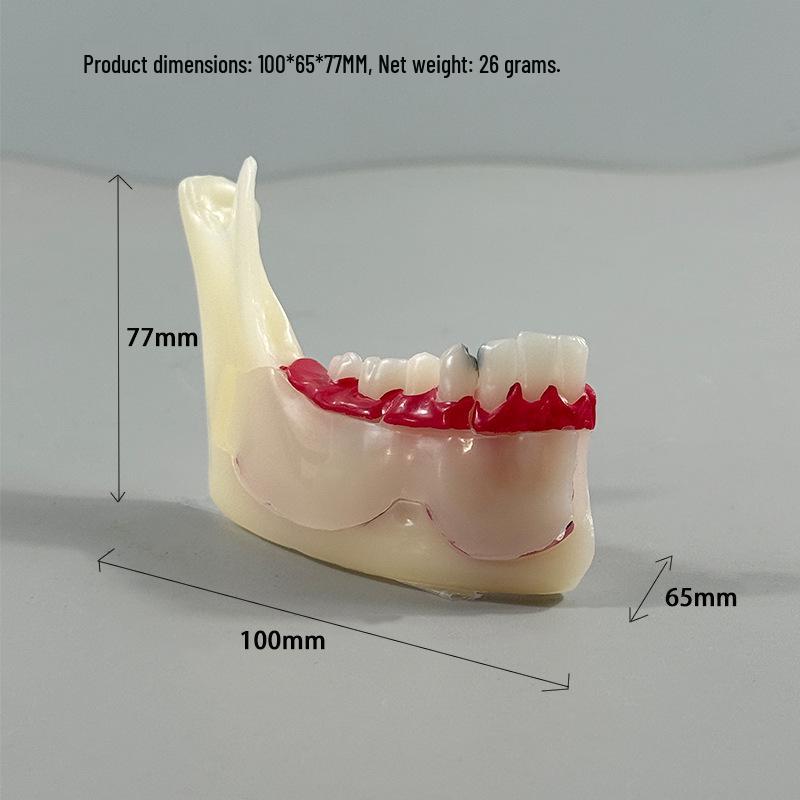 Прозора Знімна Повна Модель Щелепи з М'якими Яснами та Зубами для Підготовки до Імплантації
