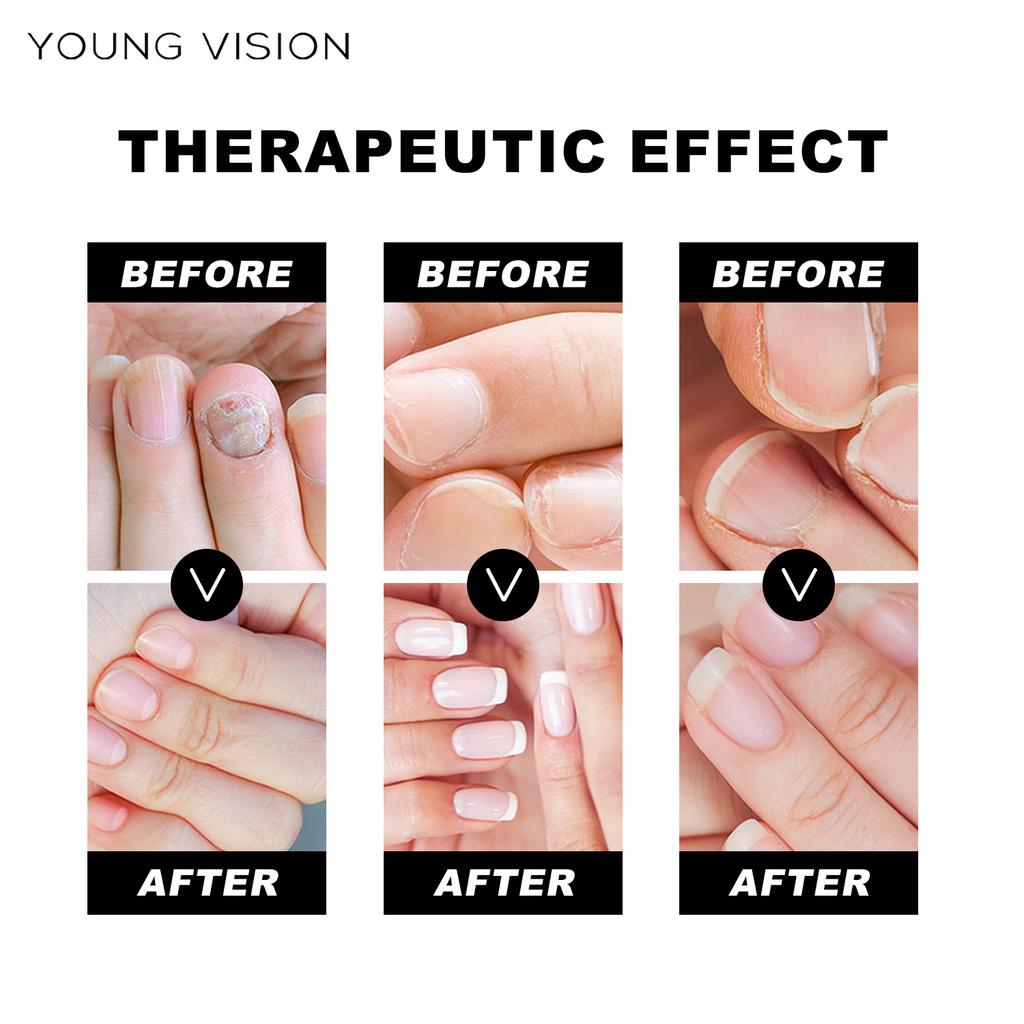 YOUNG VISION 7 Tage Nagelreparaturserum, Stärkt & Repariert Beschädigte Nägel
