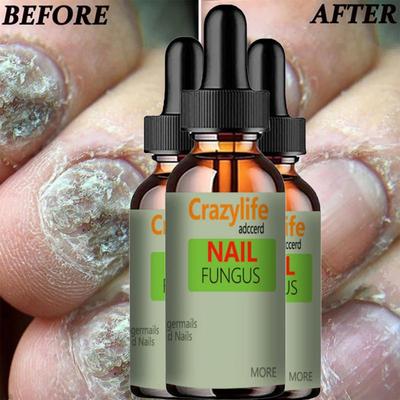 El ve Ayak Tırnak Onycho Onarım Tırnak Onychomycetant Tırnak Kalınlaştırma Baskılayıcı