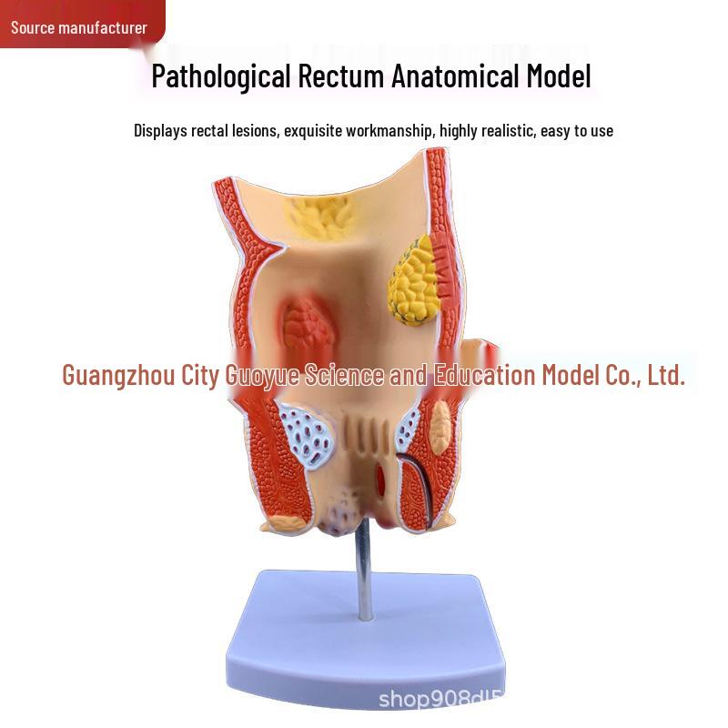 Human Rectum and Large Intestine Model for Medical Teaching and Patient Communication
