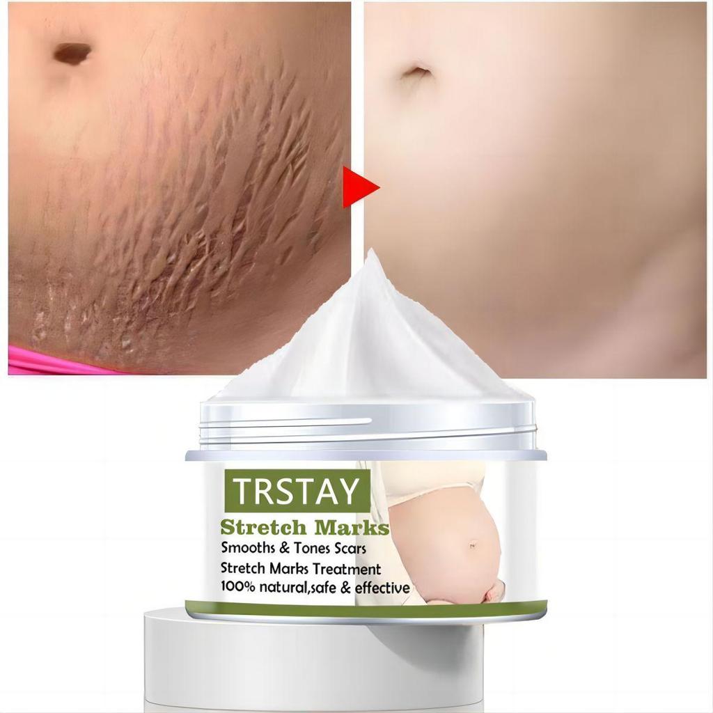 Mild Without Irritation Stretch Mark Spray Repair Removal Acne Scar Stretch Marks Cream Fat Scar Striae Gravidarum