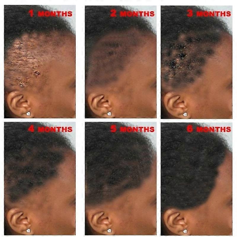 New Fast Hair Growth Serum African Crazy Regrowth Traction Alopecia Hair Loss Prevent Edges Bald