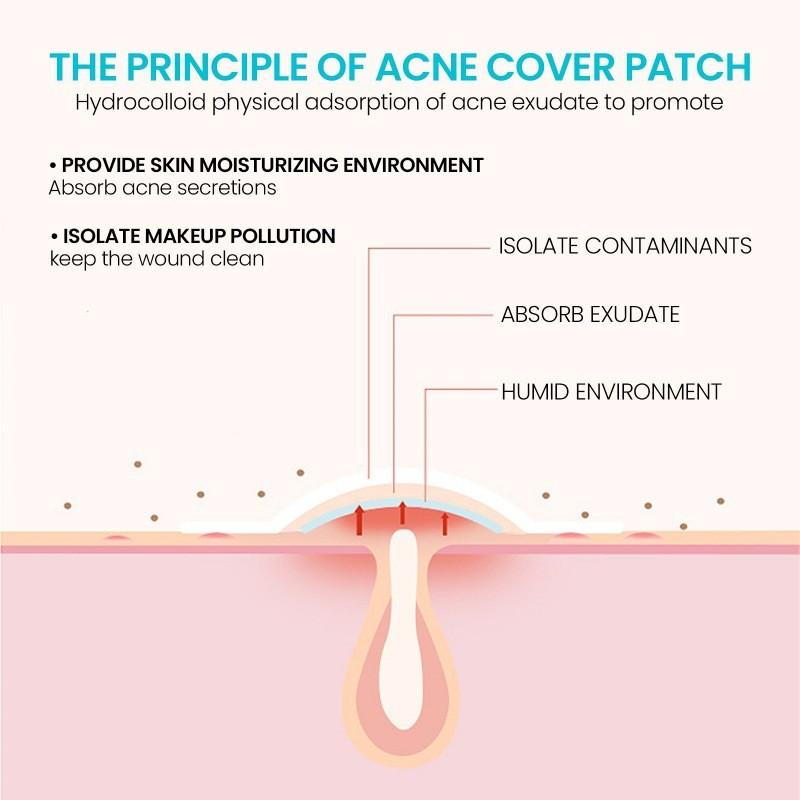 Ouhoe Acne Patches Gentle And Non-irritating Hydrocolloid Stickers For Flawless Skin 72pcs