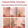 JingPeiTang Sulfur Soap for Acne, Mites & Oil Control