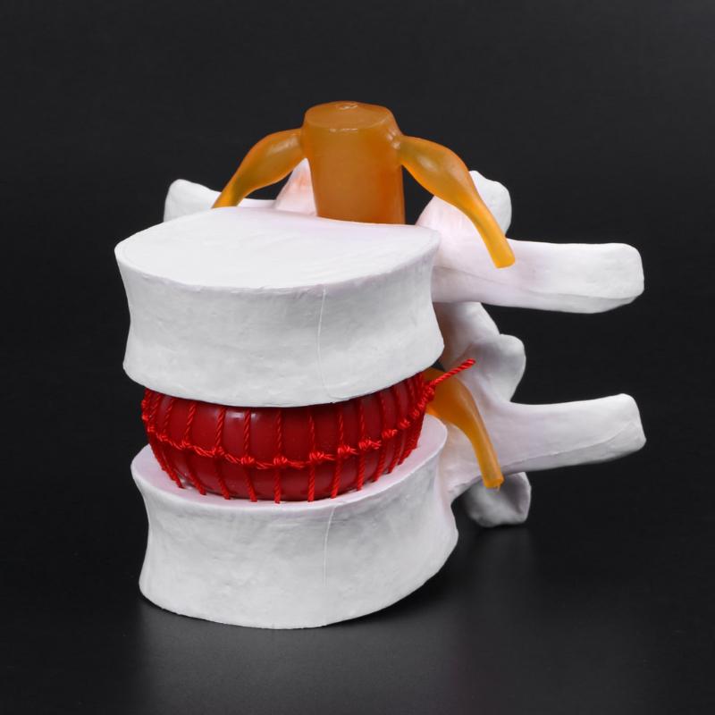 Human Anatomical Lumbar Disc Herniation Model Medical Learn Aid Anatomy Instrume Human Anatomical Lumbar Disc Herniation Model Medical Learn Aid Anatomy Instrume
