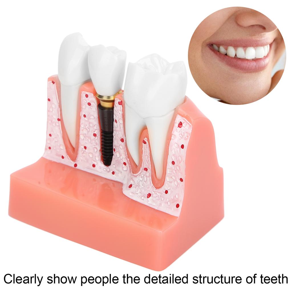 Teeth Model Dental Implant Analysis Crown Bridge Model Demonstration Tooth Model