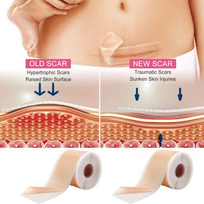 Silicone Scar Sheets Scar Tape Roll Professional Soft Scar Strips for Surgical Scars Keloids Acne Scar Treatment Silicone Gel Patch