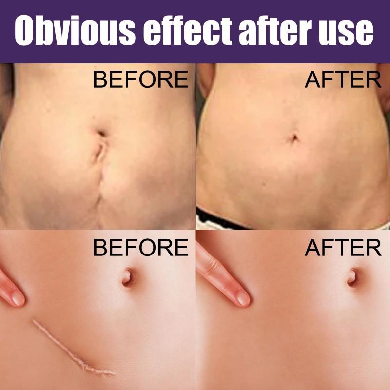 Eelhoe Silikon Narbenpflaster zur effektiven Reduzierung von Schwangerschafts- und Kaiserschnittnarben