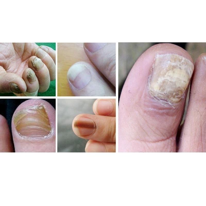 3ml Nail Problem Treatment of Onychomycosis Repair 1 Bottle Bacteriostat  5 Bottles for 30 Days