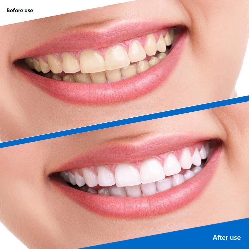 Autocollants 3D pour dents blanches: Blanchiment des dents et élimination des taches pour un sourire magnifique et éclatant.