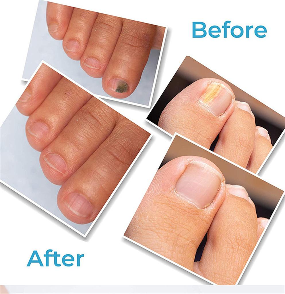 Toenail Fungus TreatmentExtra Strong, Nail Care TreatmentExtra Strong For Thick, Discolored And Damaged Nails 3ML