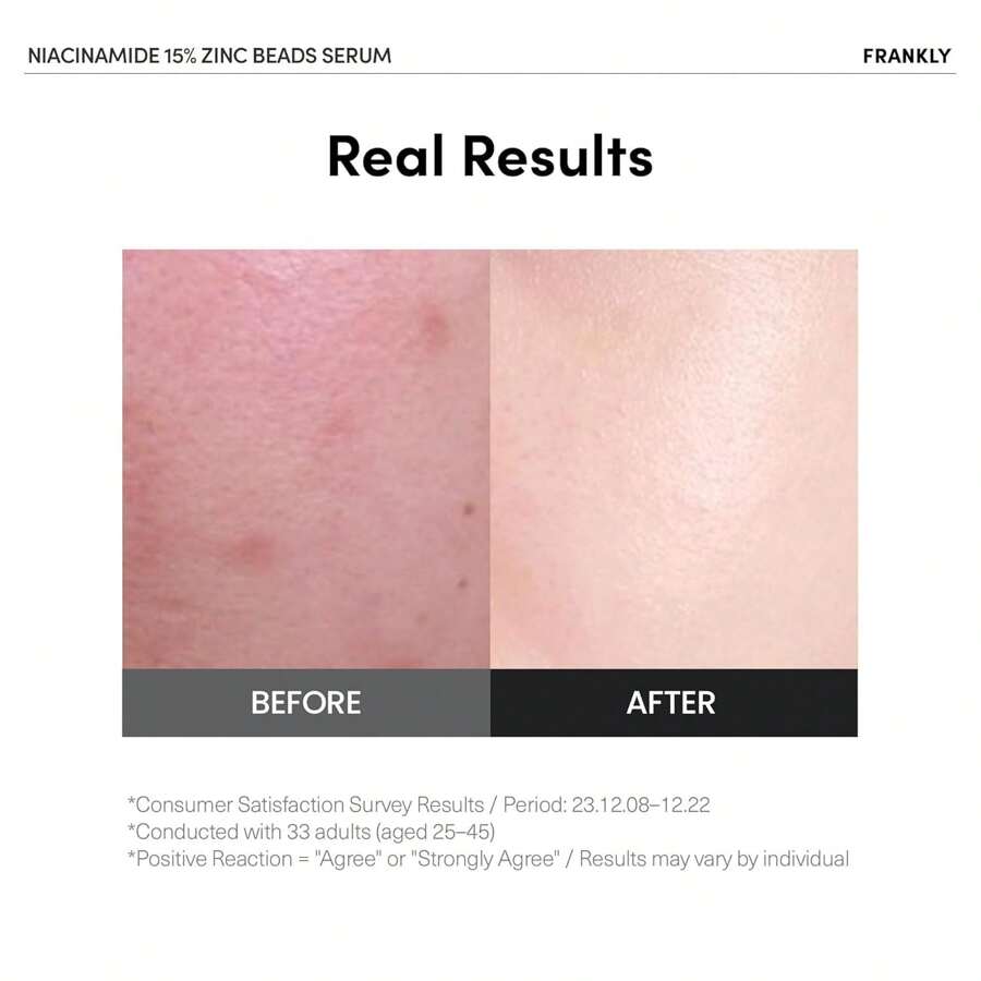 FRANKLY Niacynamid 15% & Serum z Kuleczkami Cynku 30ml : Pielęgnacja trądziku i ciemnych plam, kontrola sebum, wyrównana tekstura skóry i blask | Wegańskie i nietestowane na zwierzętach
