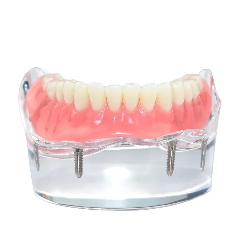 Modello Denti Dentali Trasparente 4 Impianti Overdenture Ponte Rimovibile Modello Mandibolare Inferiore M6003 Materiali per Studio Dentistico
