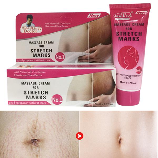 stretch marks remover