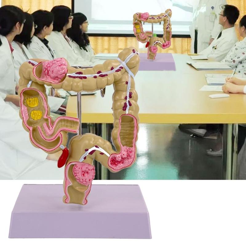 Menschliches Dickdarmmodell für Anatomie, Medizin, Lehrmodell, Pathologien des Dickdarmmodells für Studium und Ausstellung