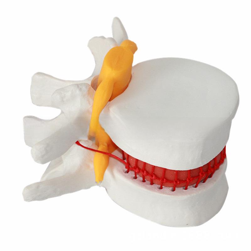 Genuine Lumbar Spine Protrusion & Vertebra Pathology Model