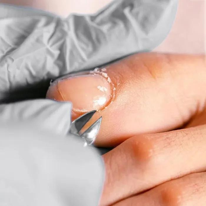 Thick Ingrown Toenail Nail Clippers Cuticle Remover Nail Nippers