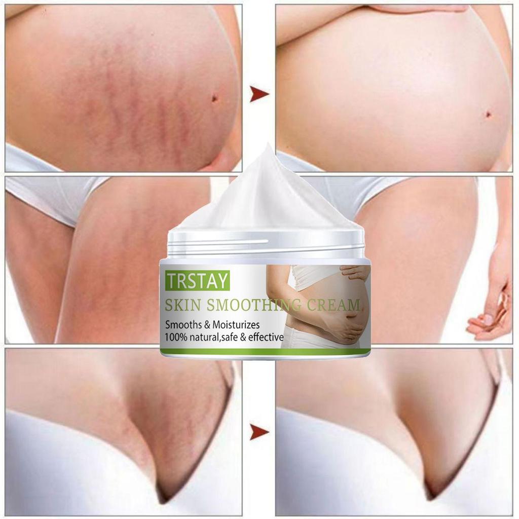 Stretch Mark Cream Pregnant Women Postpartum Stretch Marks  Crema Para Blanquear La Cara Skin Whitening Cream