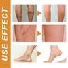 Premium Varicose Vein Repair Cream Relieves Soreness Swelling And Bulging Veins