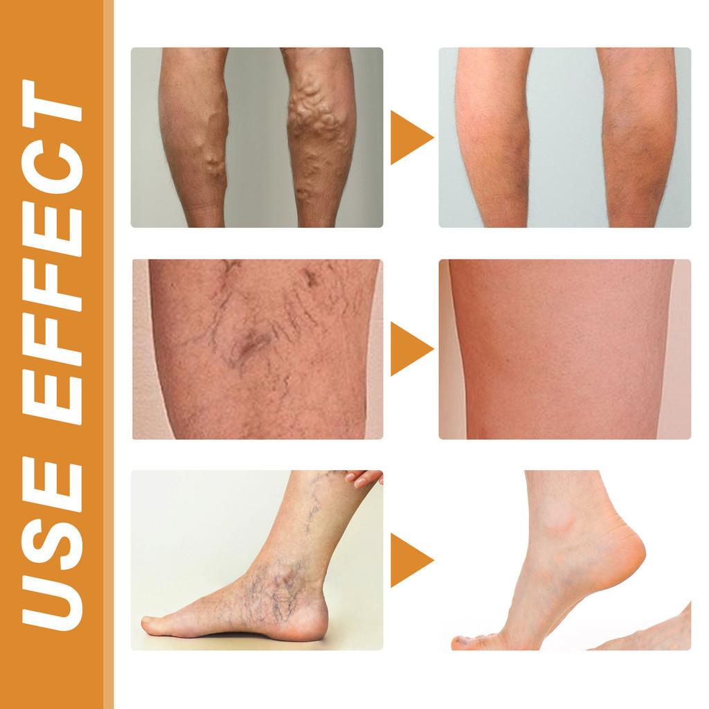 Premium Varicose Vein Repair Cream Relieves Soreness Swelling And Bulging Veins