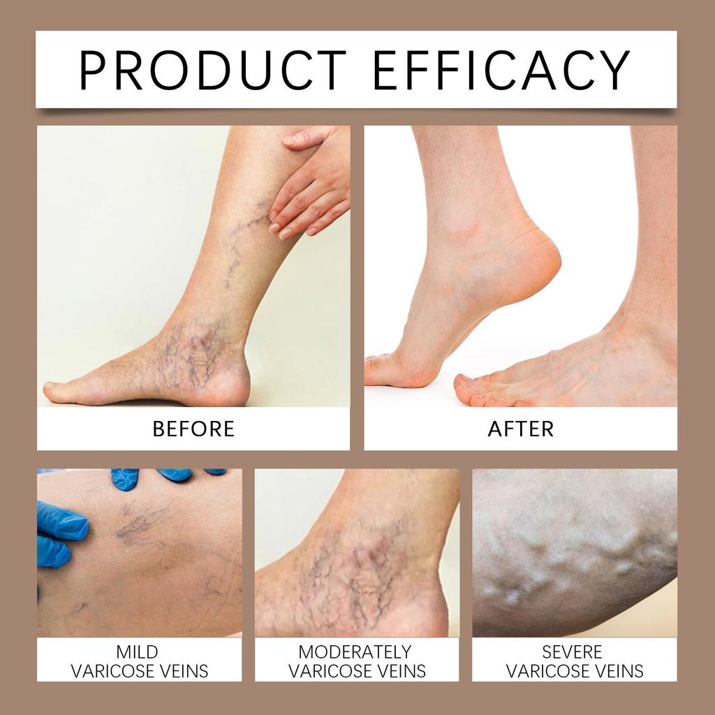 Varicose Veins Ointment Eliminate Spider Legs Vein Relieve Vasculitis Phlebitis Massage Moisturizing Legs Pain Treatment Cream