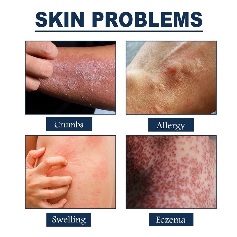 South Moon Skin Care Spray For Relief Of Itchy Skin And Eczema Symptoms In 30ml Bottle