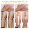 Varicose Veins, Varicose Veins, Pain Ointment, Varicose Veins, Varicose Veins