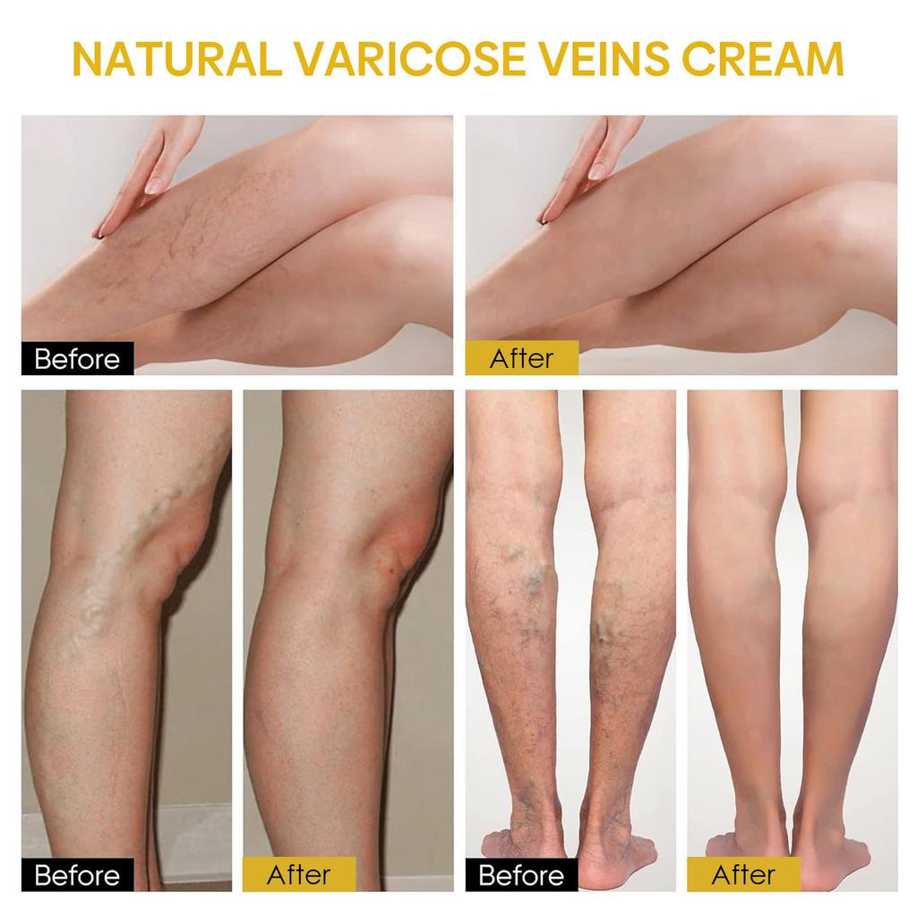 Varicose Veins, Varicose Veins, Pain Ointment, Varicose Veins, Varicose Veins