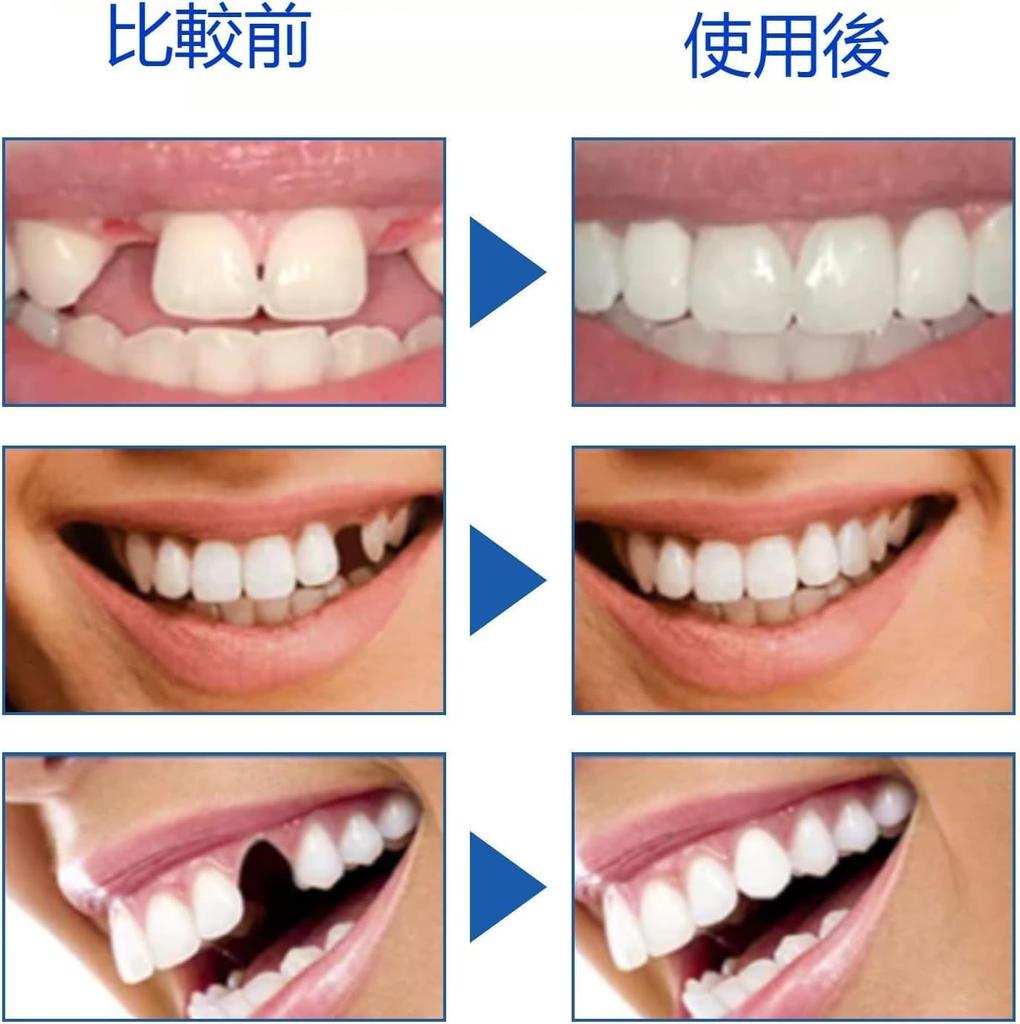 Dental Cement for Gapped Teeth, 30ml, DIY Dentures, Simple To Use, Natural Fit, Made In Germany, Removable At Any Time (1 Count)