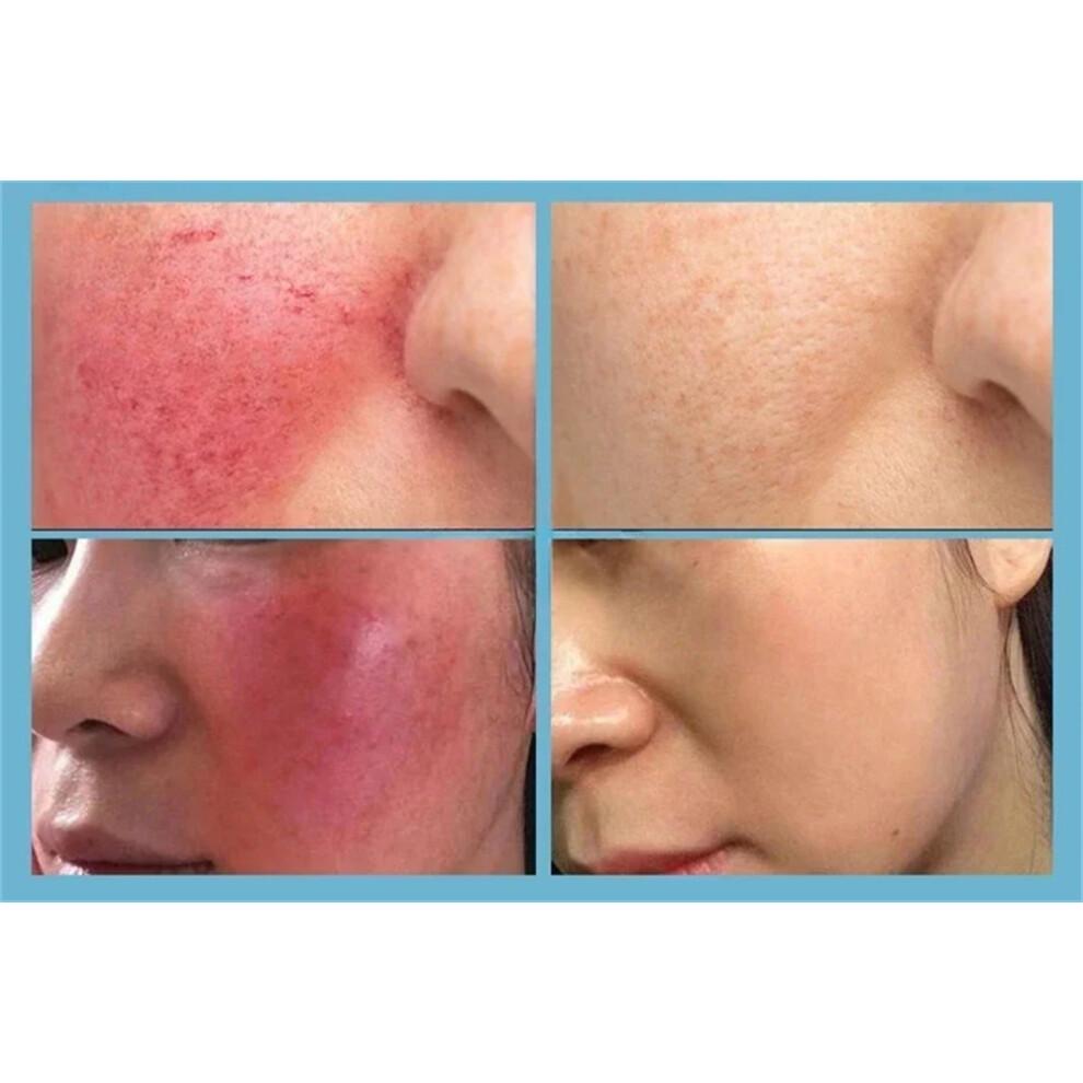 Repair Facial Redness Serum Instant Spider Vein Remove Sensitive Skin Sooth Anti Redness Rosacea Treat Lotion Korean Cosmetics