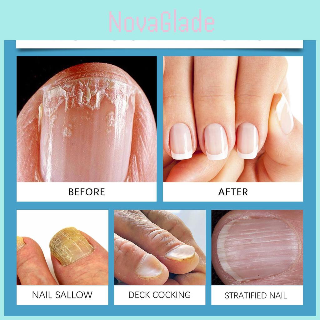 Eohoe Hand Nail Care Device For Gentle Nourishing Strengthening And Fortifying Nails