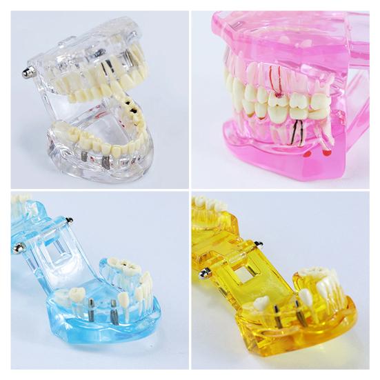 Dental Implant Model Teaching Aid for Dentist Student School Removable Teeth