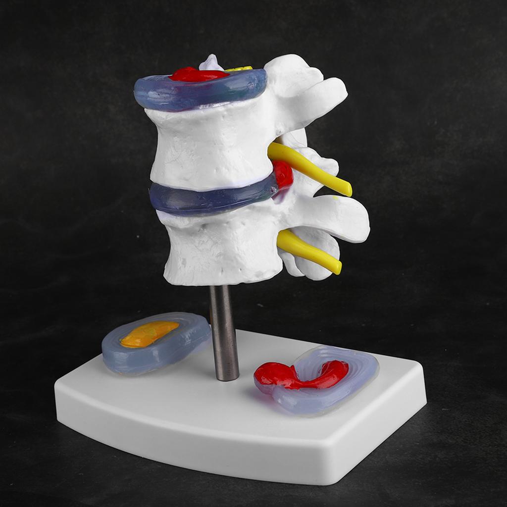 Anatomical Lumbar Disc Herniation Demonstration Model Human Spine School Training Supplies