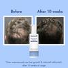WishCare Concentrate  Hair Growth Serum 100ml For Men & Women With Redensyl, Anagain, Baicapil, Caffeine, Biotin