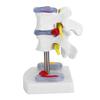 Anatomical Lumbar Disc Herniation Demonstration Model Human Spine School Training Supplies