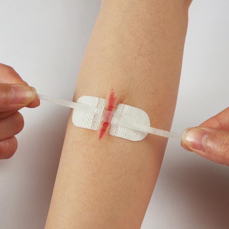 Zippered Suture-Free Tape Closure with Waterproof Patch
