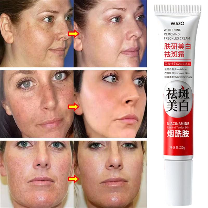 Powerful Spot-Removing Whiten Cream Brighten Skin Fast Eliminates Melanin Pigmentation Melasma Dark Spots Korean Skin Care