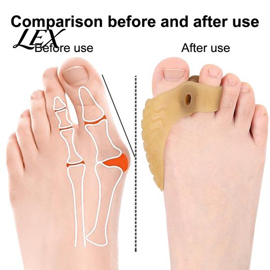 Hallux Valgus Corrector 1 Pair Toe Separator for Overlapping Toes, Soft SEBS Bunion Corrector, Double Breathable Hole Foot Spacer Valgus, Straightener