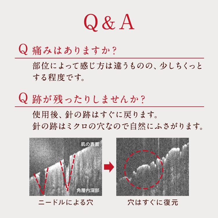 CONC Faltenunterspritzung Mikronadel-Nadel-Serum Nadel-Serum Nasolabial-Shot Nadel-Serum 2,5 ml