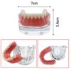 Dental Teeth Model With Implants Gold/Silver Bar Type Overdenture Restoration Treatment Typodont For Dentist Patient Teaching