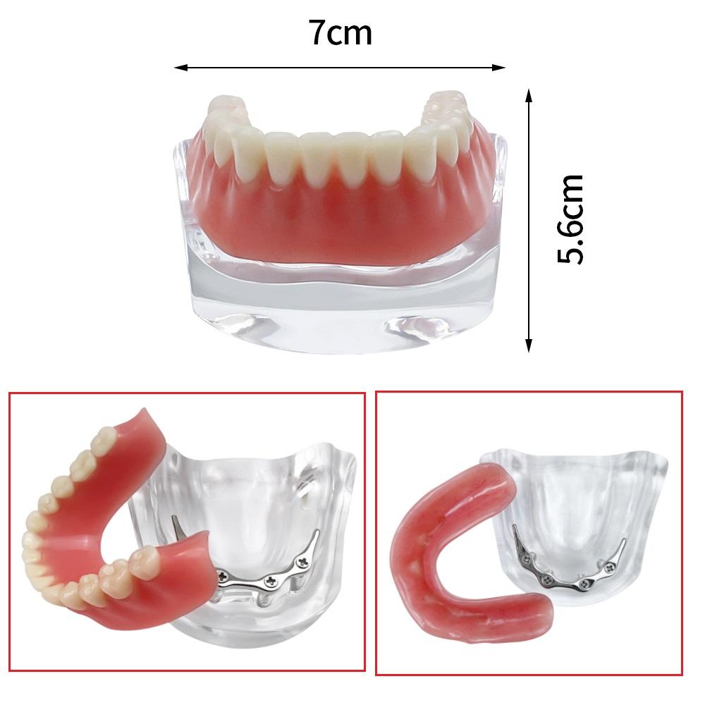 Dental Teeth Model With Implants Gold/Silver Bar Type Overdenture Restoration Treatment Typodont For Dentist Patient Teaching
