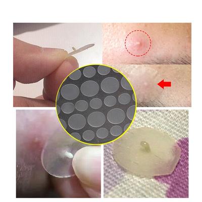 Autocollant dissolvant d'acné, 36/72/108 pièces, traitement des points noirs, plâtre, Patch de boutons d'acné, masque, outil de soins du visage, soins de la peau