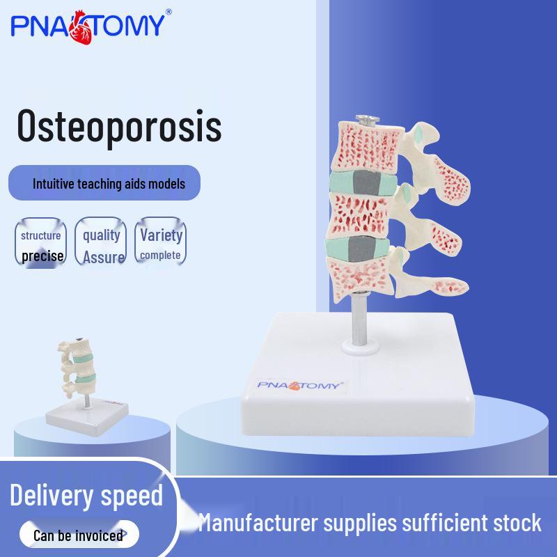 Osteoporosis Cervical Vertebra & Joint Bone Model 11cm x 11cm x 15cm