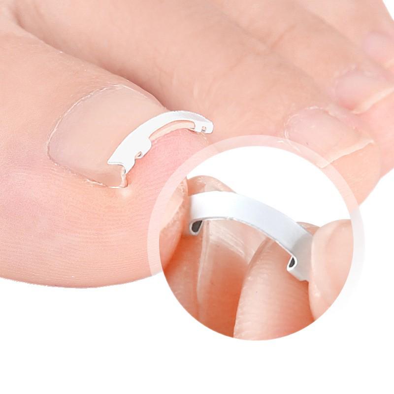 Nickel-Titanium Ingrown Toenail Corrector: Invisible, Wearable Nail Hook for Pain Relief