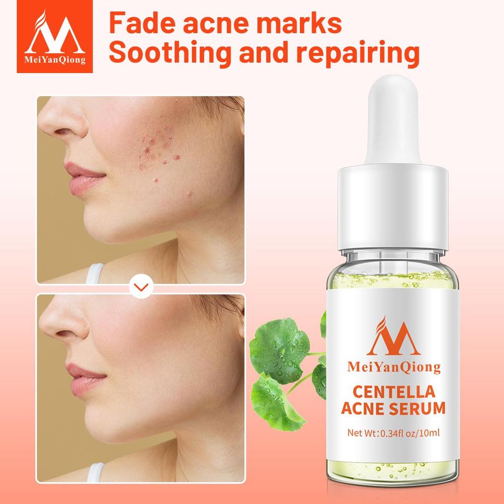 Centella Asiatica Acne Removing Essence Face Serum Liquid Moisturizing Anti Wrinkle Shrink Pore Control Oil Whiten Skin